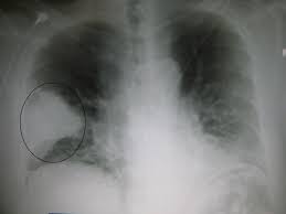 Characteristic X-ray of bacterial pneumonia.